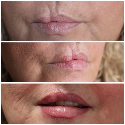 Cicatrices en labios